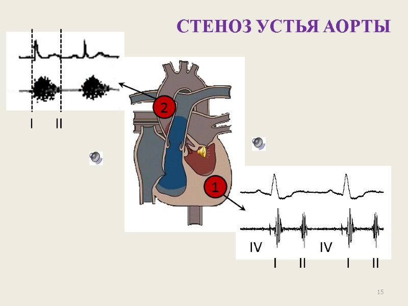 15 СТЕНОЗ УСТЬЯ АОРТЫ